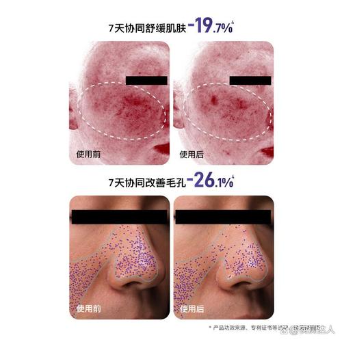 2026年美容儀品牌排行榜前10名 告別選擇困難，輕松選對優(yōu)質(zhì)美容儀